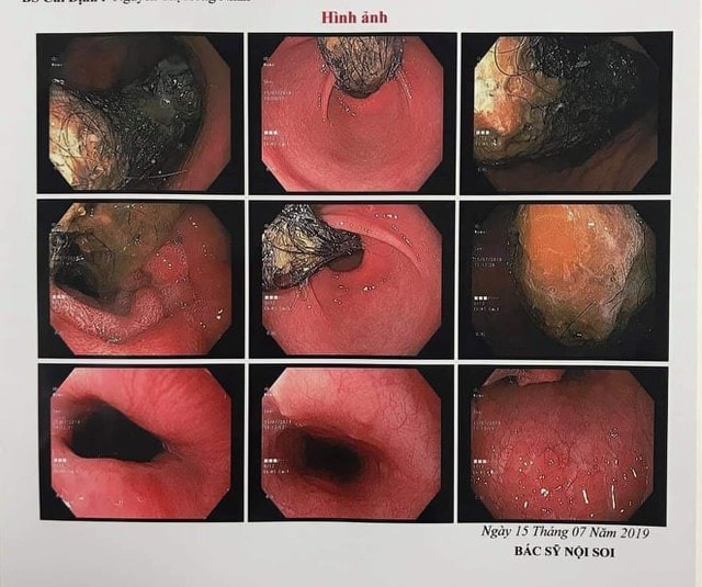 Bé 9 tuổi ở Thái Bình mắc chứng nghiện nhổ tóc để... ăn - Ảnh 1.