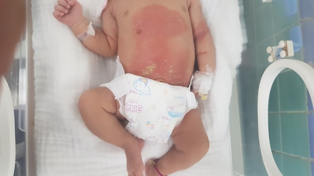 Bé 14 ngày tuổi bỏng nặng vì đắp lá trầu không chữa chướng bụng - 1 Bé 14 ngày tuổi bỏng nặng vì đắp lá trầu không chữa chướng bụng - 1