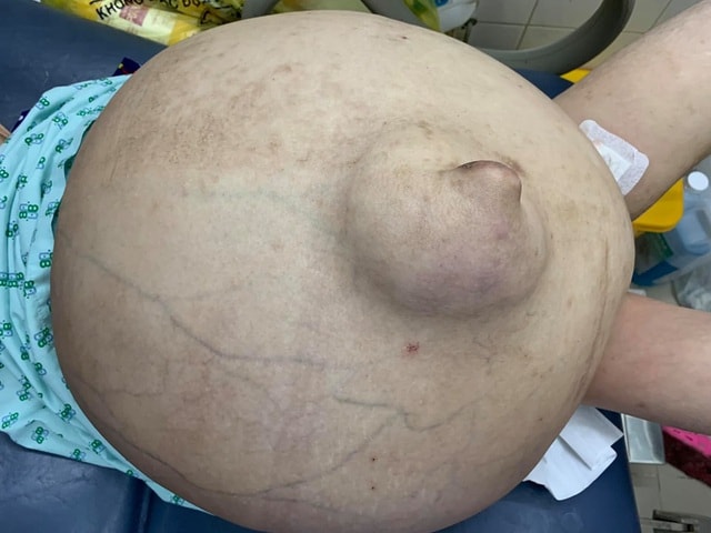 Bé gái 10 tuổi mang khối bướu khổng lồ như ễnh ương - 2