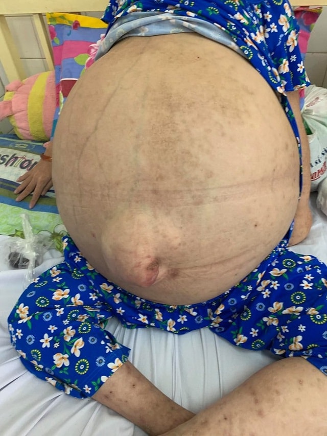 Bé gái 10 tuổi mang khối bướu khổng lồ như ễnh ương - 1