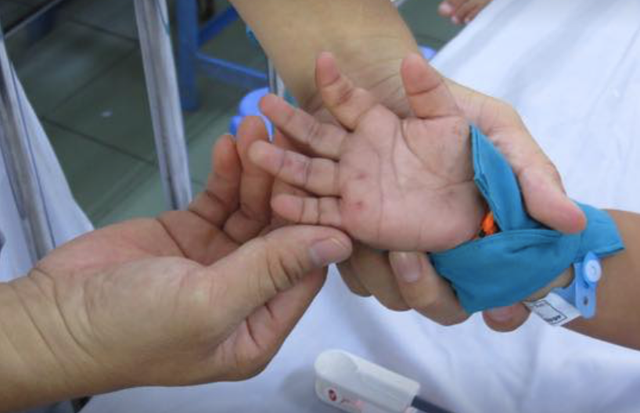 Trẻ mắc chân tay miệng phải được cách ly y tế. Ảnh: Võ Thu