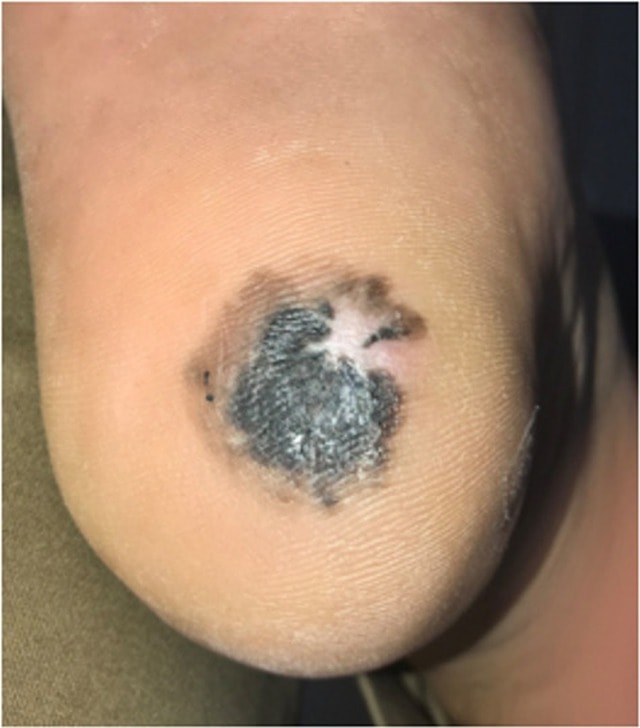 Nốt lạ trên da cảnh báo ung thư - 1 Nốt lạ trên da cảnh báo ung thư - 1