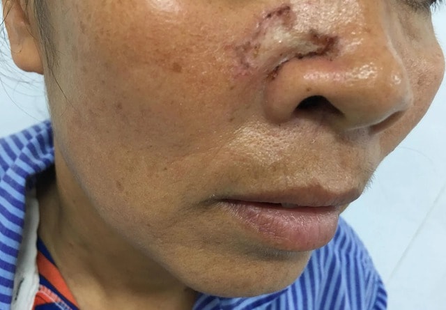 Nốt lạ trên da cảnh báo ung thư - 2 Nốt lạ trên da cảnh báo ung thư - 2