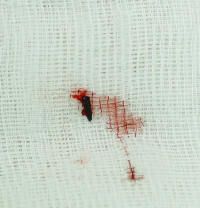 Hy hữu đầu bút chì nằm trong hốc mắt bé trai suốt 5 năm - 2