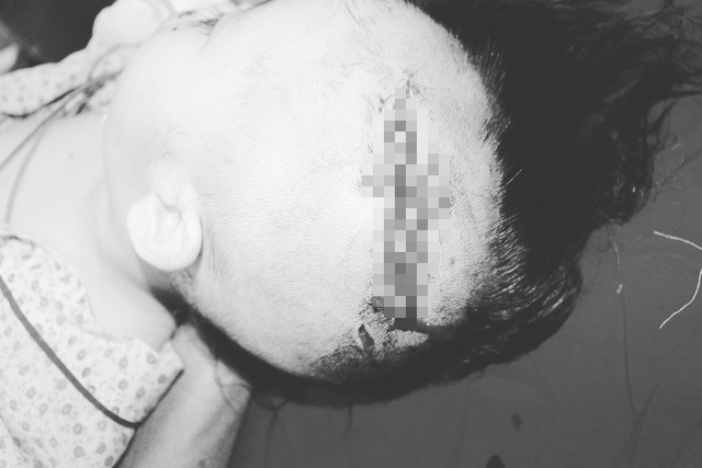 Bé trai 2 tuổi ở Hà Nội bị chó cắn lộ xương sọ - Ảnh 1.