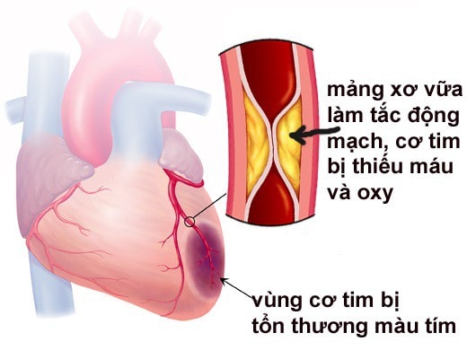 Căn bệnh khiến NSND Thế Anh qua đời là nguyên nhân gây đột tử hàng đầu, nhiều người trẻ mắc - Ảnh 2.