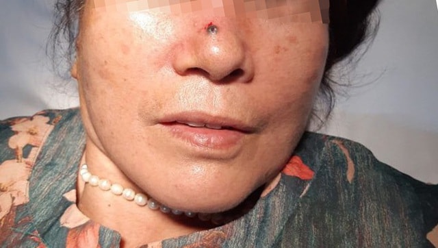 Tưởng nốt ruồi bình thường hóa ung thư da - 1