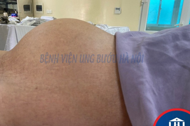 Cụ bà 81 tuổi bụng to như có bầu 6 tháng - 1