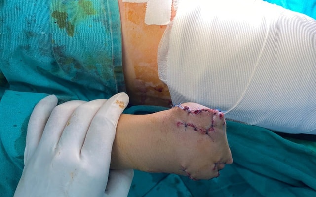 Lên mạng học chế tạo pháo, trẻ 13 tuổi bị cụt tay - 1