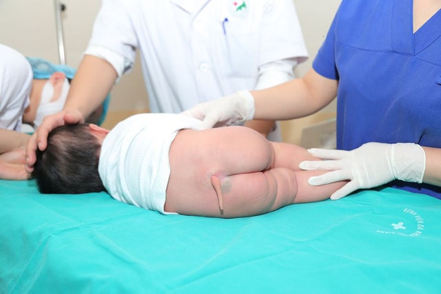 HIẾM: Cắt bỏ dị tật còn đuôi bẩm sinh ở bệnh nhi 5 tháng tuổi - Ảnh 2.