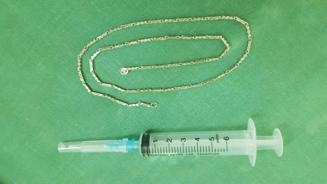 Sợi dây chuyền dài gần 40cm trong dạ dày của trẻ - 2