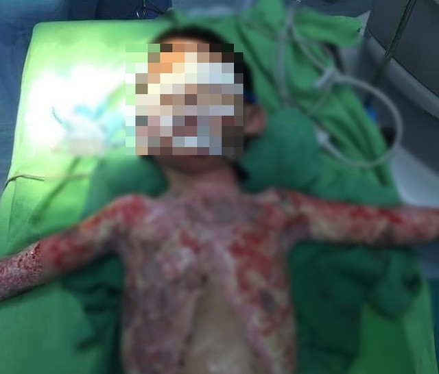 Nghịch bật lửa, bé trai 5 tuổi bị bỏng nặng toàn thân - 1