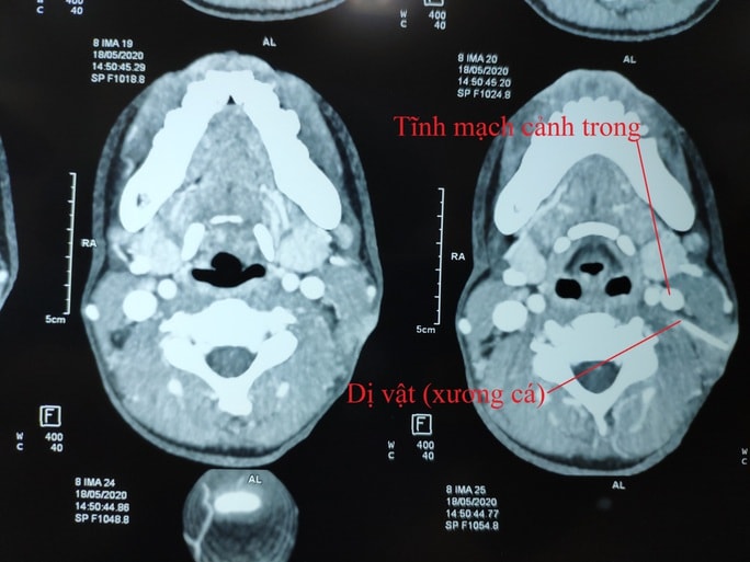 Hóc xương cá 5 tháng nhưng trị bằng cách dân gian, bé gái suýt mất mạng - Ảnh 2.