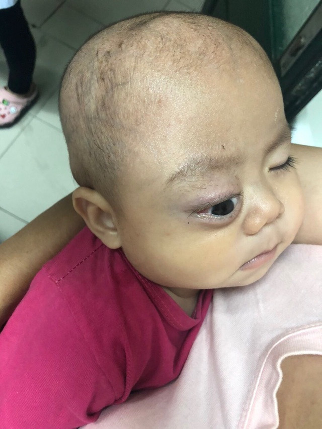 Xót thương bé trai dân tộc Nùng 7 tháng tuổi bị khối u đẩy lồi mắt ra ngoài - Ảnh 2.