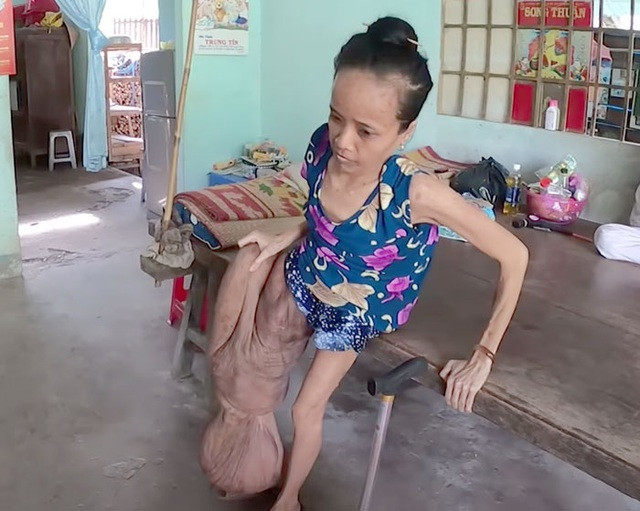 Cảnh đời buồn của người phụ nữ có chân to nhất Việt Nam - Ảnh 2.