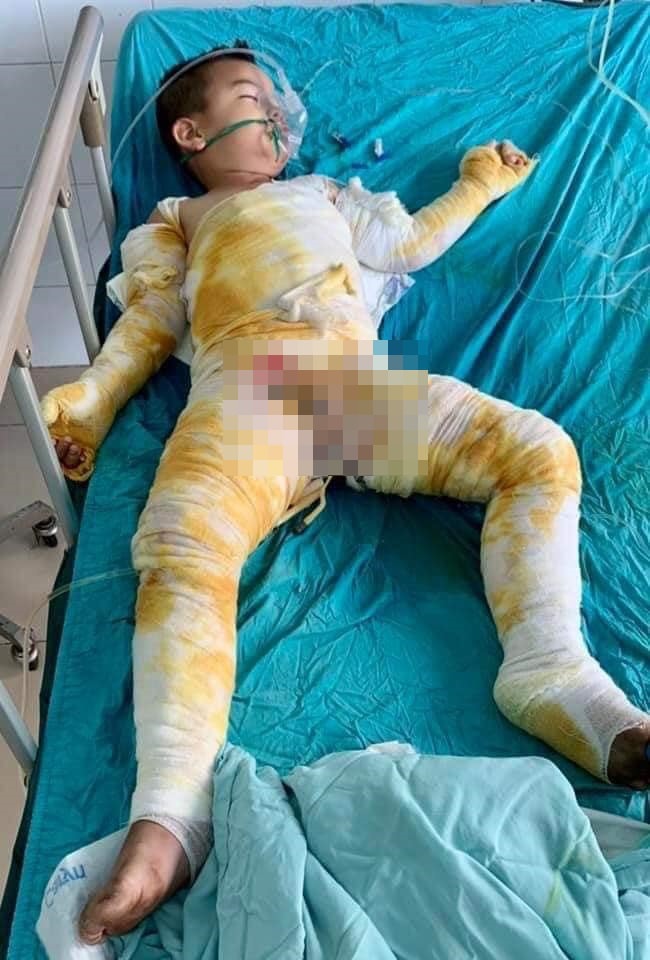 Chồng mất, 3 mẹ con bị bỏng nặng sau vụ cháy điều hòa đang rất cần sự giúp đỡ  - Ảnh 4.