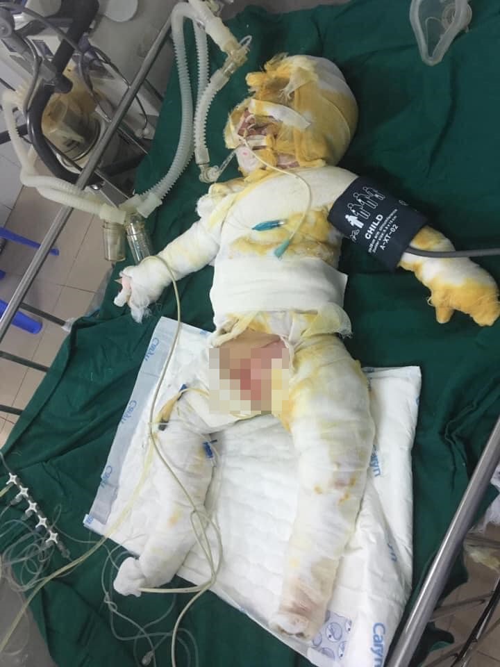 Chồng mất, 3 mẹ con bị bỏng nặng sau vụ cháy điều hòa đang rất cần sự giúp đỡ  - Ảnh 3.