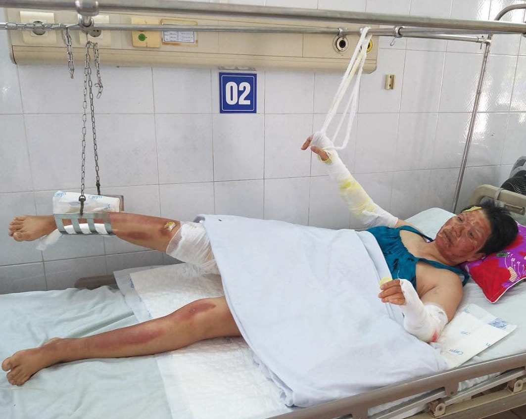 Chồng mất, 3 mẹ con bị bỏng nặng sau vụ cháy điều hòa đang rất cần sự giúp đỡ  - Ảnh 2.