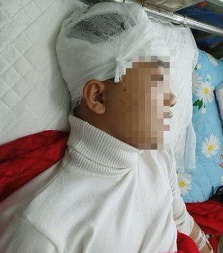 Bắt giam đối tượng đánh nam sinh lớp 11 chấn thương sọ não - Ảnh 1.
