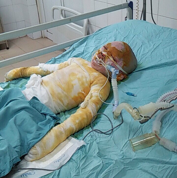 Cơ thể biến dạng, mặt loang lổ do bỏng cồn, bé gái 5 tuổi khẩn thiết cần sự giúp đỡ - Ảnh 3.