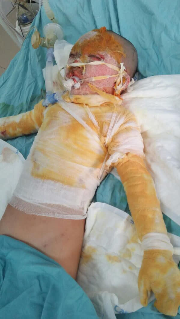 Cơ thể biến dạng, mặt loang lổ do bỏng cồn, bé gái 5 tuổi khẩn thiết cần sự giúp đỡ - Ảnh 2.