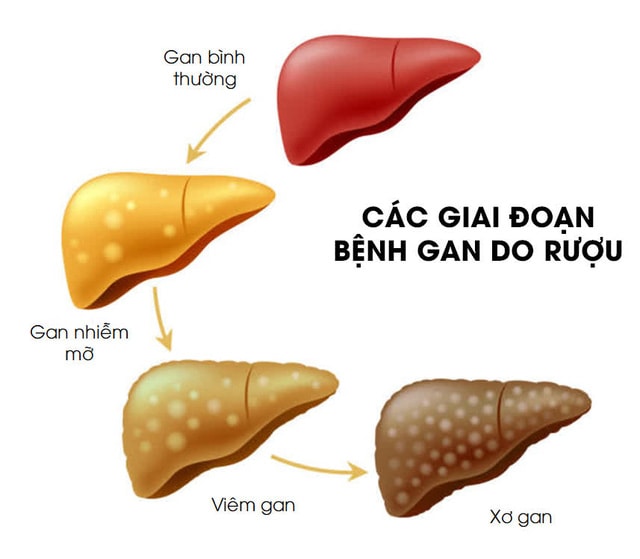 Bệnh gan do rượu: Triệu chứng và yếu tố nguy cơ ai cũng cần phải biết - Ảnh 2. Bệnh gan do rượu: Triệu chứng và yếu tố nguy cơ ai cũng cần phải biết - Ảnh 2.