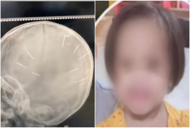 Diễn biến mới về sức khỏe của bé gái 3 tuổi bị ghim đinh vào đầu - Ảnh 1.