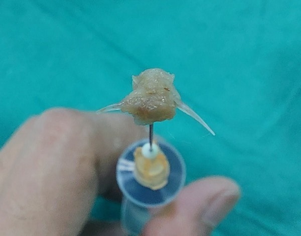 Nghệ An: Bé 2 tuổi tím tái vì hóc xương cá - Ảnh 1.