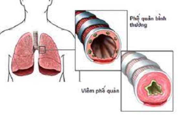 Cách điều trị viêm phế quản để bệnh không tái phát - Ảnh 1.