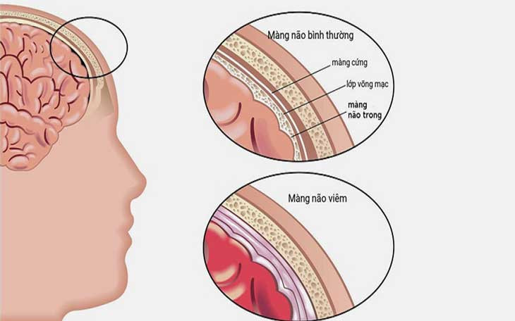 Viêm màng não mủ cần phân biệt với các loại bệnh nào? - Ảnh 1.