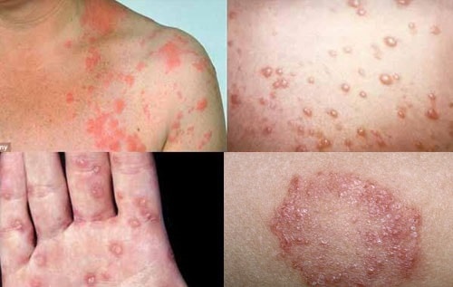 Bệnh lậu nguy hiểm với phụ nữ mang thai như thế nào? - Ảnh 1. Bệnh lậu nguy hiểm với phụ nữ mang thai như thế nào? - Ảnh 1.