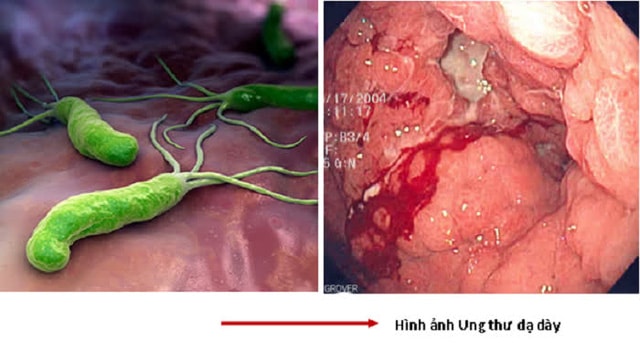 Độ tuổi nào nên soi dạ dày để phát hiện ung thư sớm? - Ảnh 1.