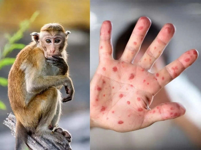 Ghi nhận ca bệnh đậu mùa khỉ đầu tiên tại TP. HCM, cần làm gì để tránh nhiễm bệnh? - Ảnh 1.