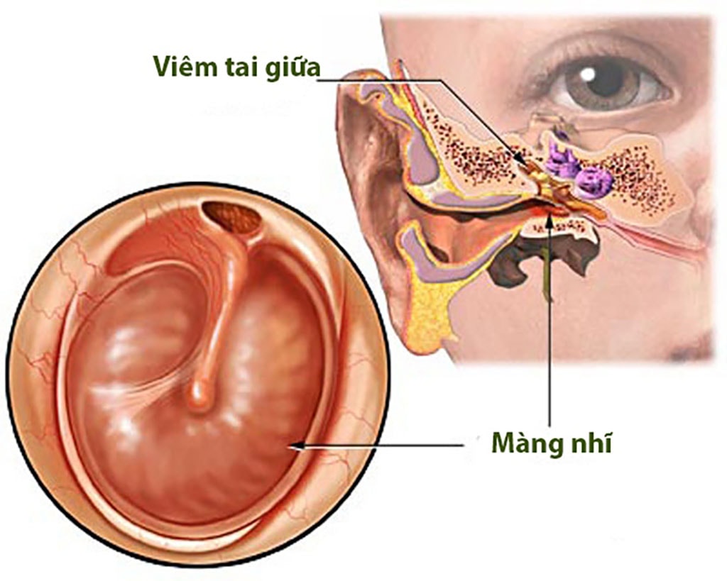 Yếu tố nguy cơ và biến chứng viêm tai giữa cấp ở trẻ - Ảnh 1.