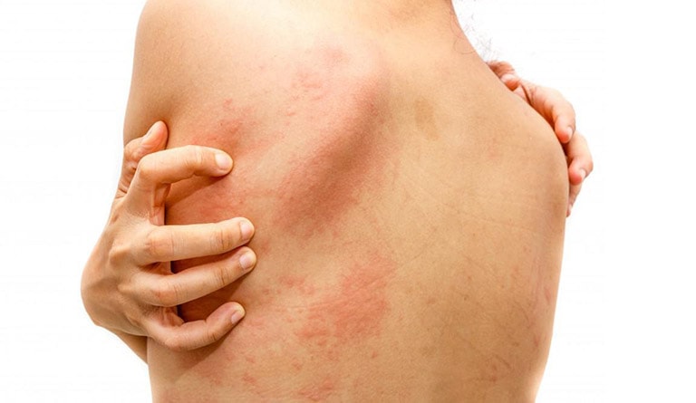 Nhận biết nguyên nhân và khắc phục tình trạng phát ban đỏ trên da - Ảnh 4.