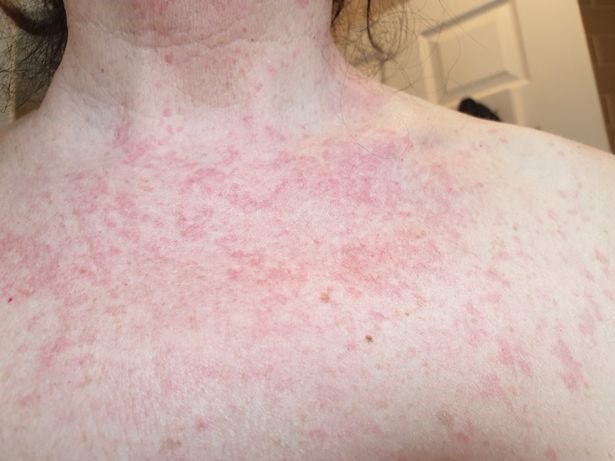 Nhận biết nguyên nhân và khắc phục tình trạng phát ban đỏ trên da - Ảnh 2.