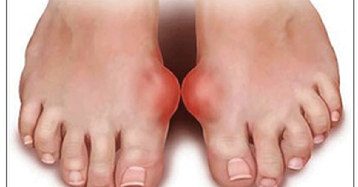 Những sai lầm thường gặp ở người bệnh gout - Ảnh 1.