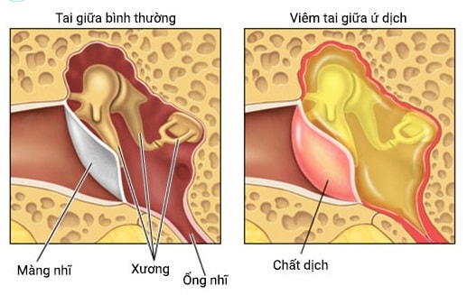 Viêm tai ứ dịch là một loại viêm tai giữa màng nhĩ đóng kín, viêm mạn tính, hay tái diễn.