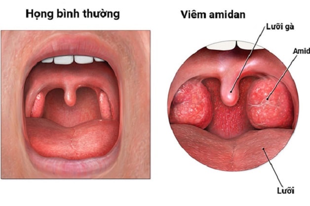 Trẻ bị viêm amidan cấp cần lưu ý gì khi giao mùa? - Ảnh 1.