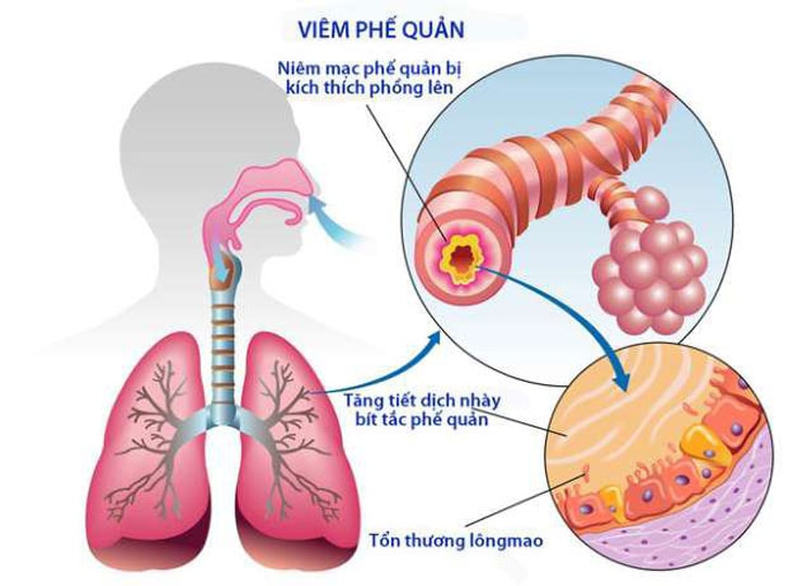 5 thực phẩm nên có trong thực đơn giúp phòng bệnh đường hô hấp lúc giao mùa - Ảnh 1.