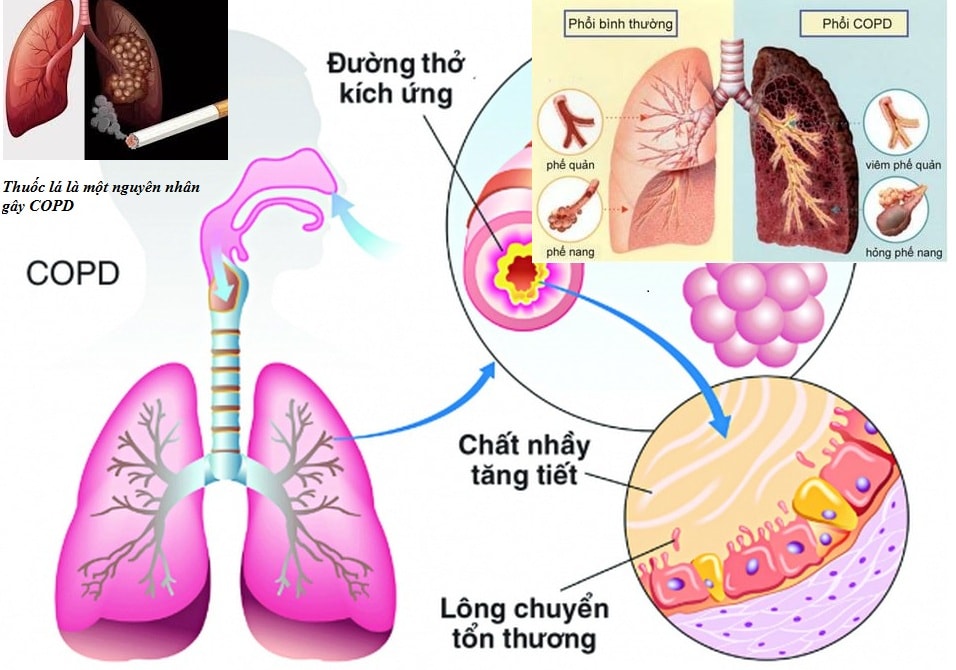 Người bệnh phổi tắc nghẽn mạn tính khỏe hơn cần thực hiện những bí quyết sau - Ảnh 1.