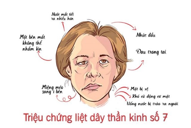 Liệt dây thần kinh số 7 ngoại biên và cách điều trị - Ảnh 1.