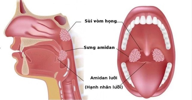 Viêm họng hạt có mủ và cách điều trị - Ảnh 2.