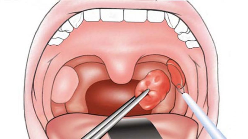 Viêm amidan mạn tính và cách điều trị - Ảnh 2.