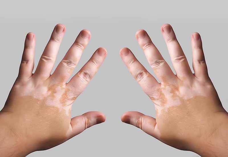 10 biến chứng tiểu đường ở da  - Ảnh 1.