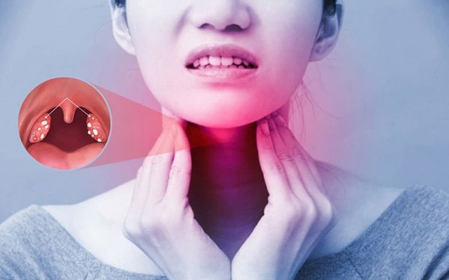 Viêm amidan mạn tính và cách điều trị - Ảnh 1.
