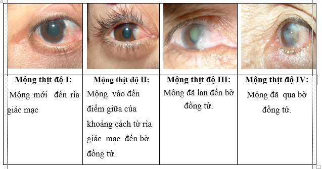 Mộng thịt ở mắt và cách điều trị - Ảnh 1.