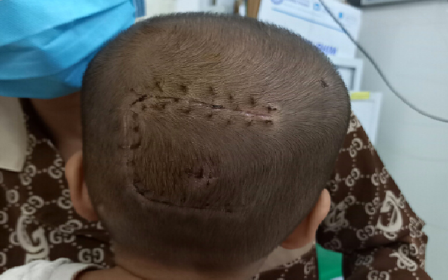 Phẫu thuật khối u màng não cho bệnh nhi 30 tháng tuổi - Ảnh 1.