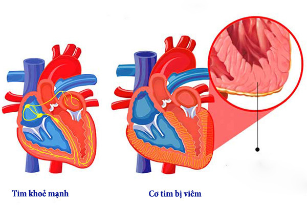 Ai có nguy cơ bị viêm cơ tim? - Ảnh 2.