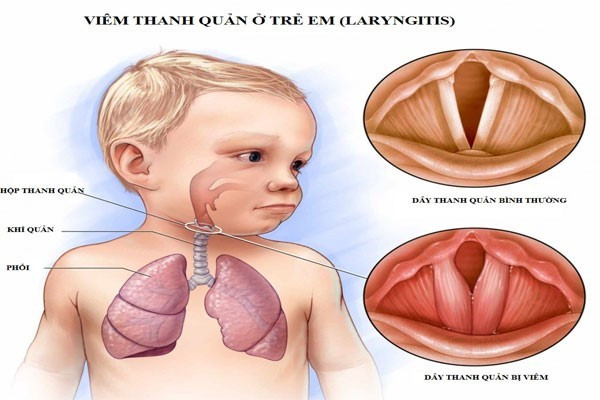 Mùa lạnh cảnh giác với viêm thanh quản cấp ở trẻ - Ảnh 2.